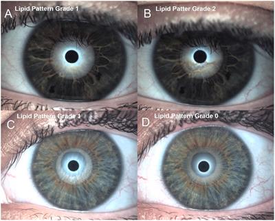 Efficacy assessment of liposome crosslinked hyaluronic acid and standard hyaluronic acid eye drops for dry eye disease management: a comparative study employing the ocular surface analyzer and subjective questionnaires